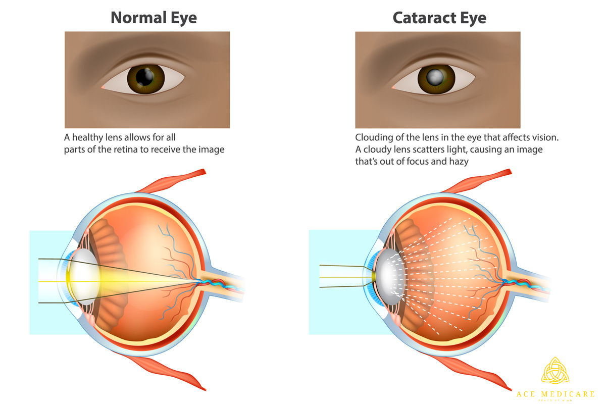 The Ultimate Guide to Cataract Surgery: Everything You Need to Know Before Going Under the Knife